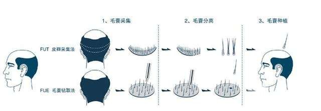 种植头发需要多少钱?秃秃们有救啦~
