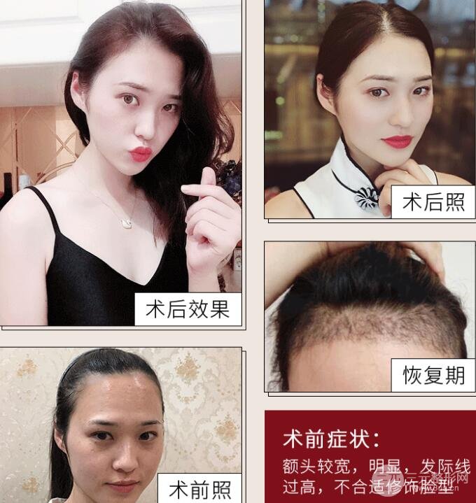 种植头发案例图