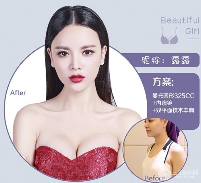 假体隆胸案例图