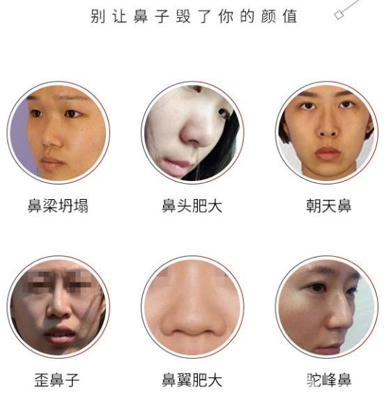 膨体隆鼻预防变形的方法