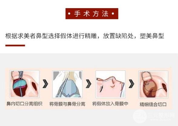 膨体隆鼻预防变形的方法