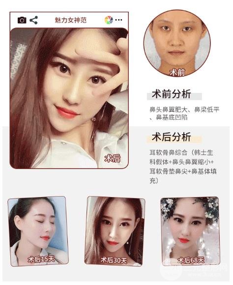 在饮食上预防膨体隆鼻变形的方法