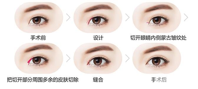 开大眼角手术后的护理不当