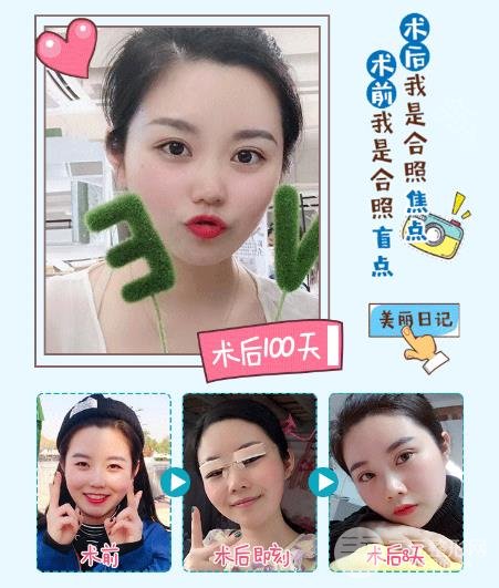 开大眼角手术预防疤痕增生现象的方法