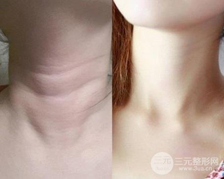 填充去除颈部皱纹的方法