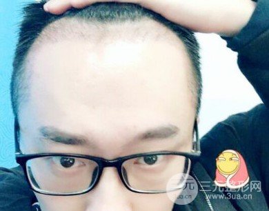 为什么植发设在这两个科室