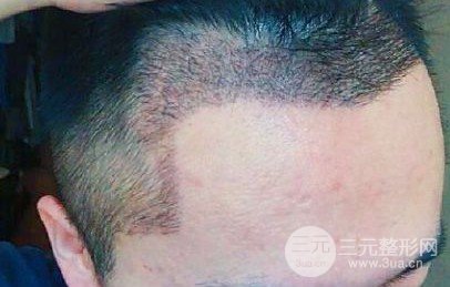 医院主流植发技术