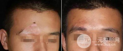 西京植发中心毛发移植果