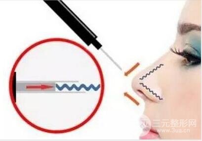医美小课堂:去除鼻唇沟的几种方法揭秘!