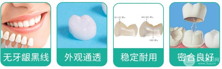 全瓷烤瓷牙的优点