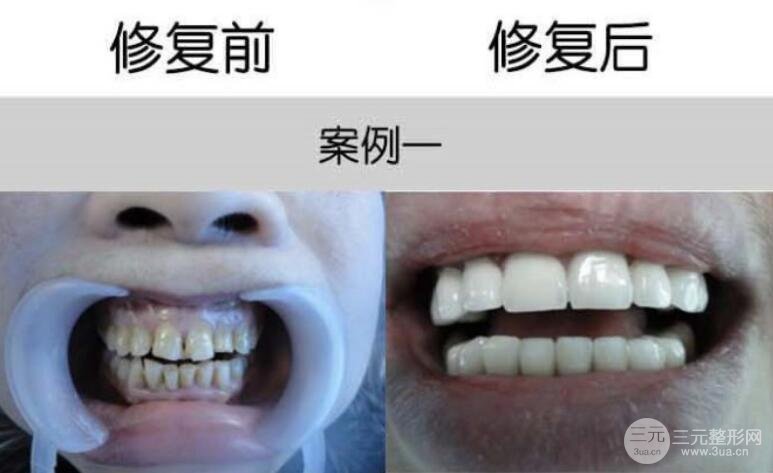 全瓷烤瓷牙案例图