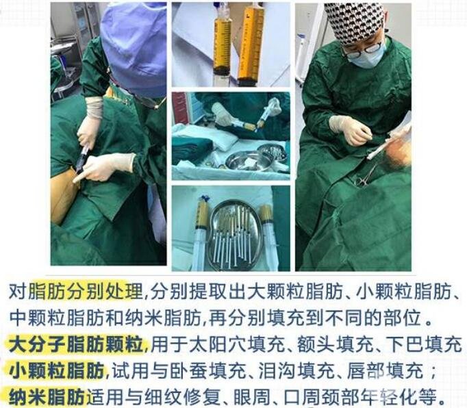 脂肪垫下巴果好不好