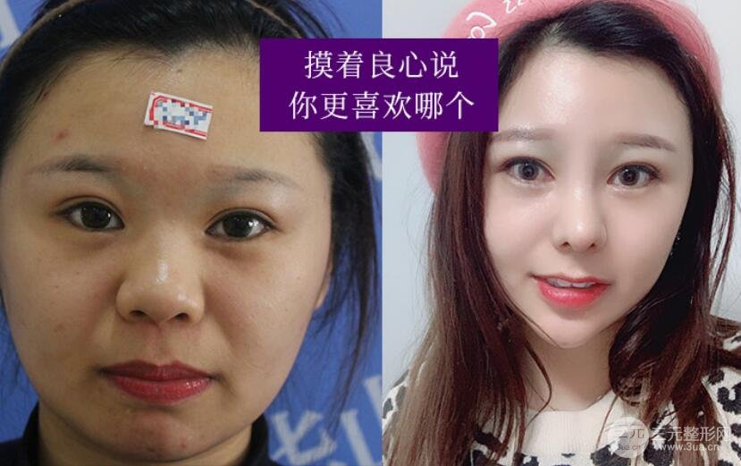 脂肪垫下巴能保持多长时间