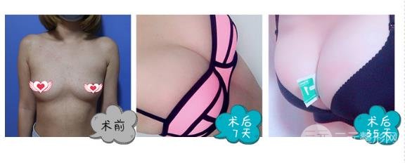 曼陀隆胸假体