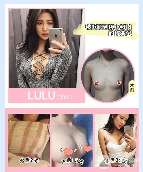 曼陀和妙桃隆胸假体哪一个会更好?