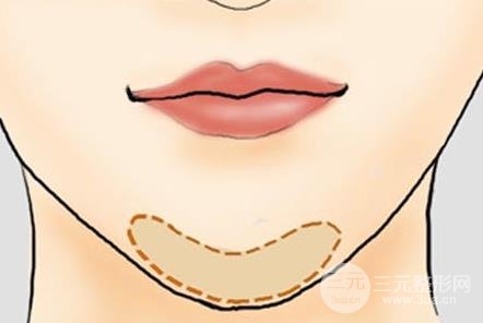 硅胶垫下巴的价格
