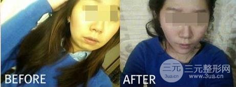玻尿酸垫下巴的价格