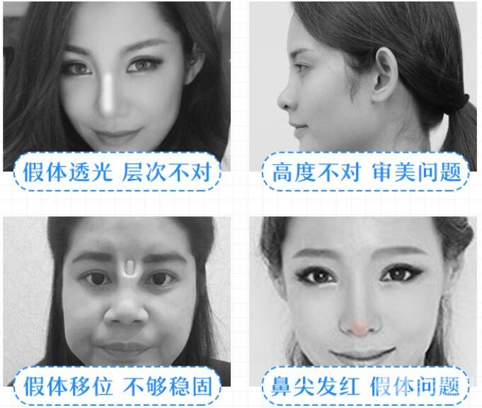 隆鼻失败怎么办?别慌,这里有自救指南!