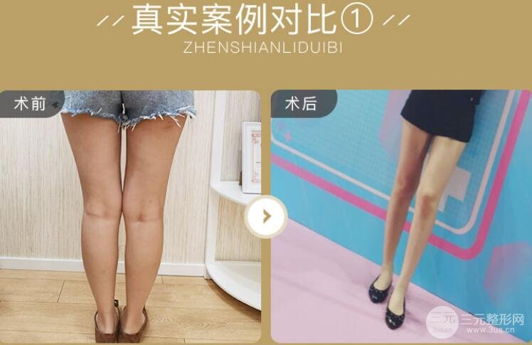 注射瘦脸瘦腿果图
