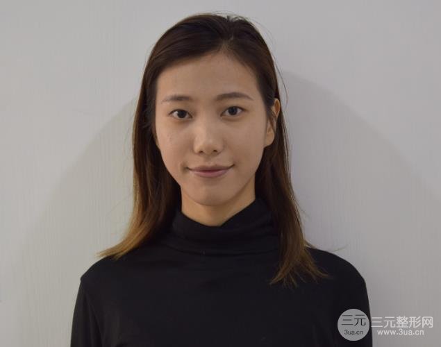 301郭伶俐好不好双眼皮隆鼻案例2月刚恢复好