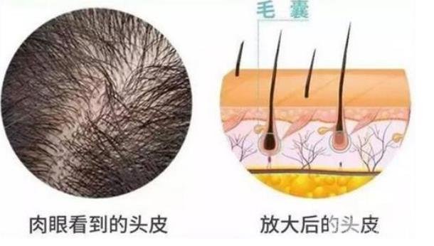 头发的种植技术有哪些?方式盘点!
