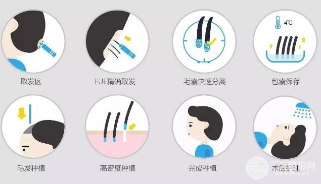 头发的种植技术有哪些?方式盘点!