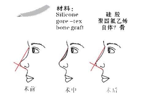 北京硅胶隆鼻手术价格