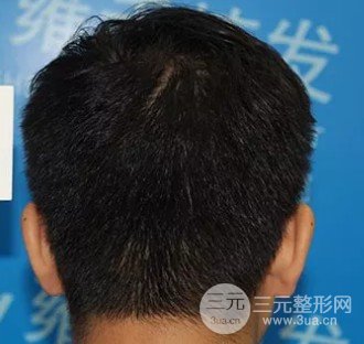 植发正规医院