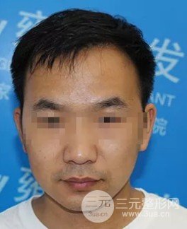 植发际线后面的头发还会长出来吗