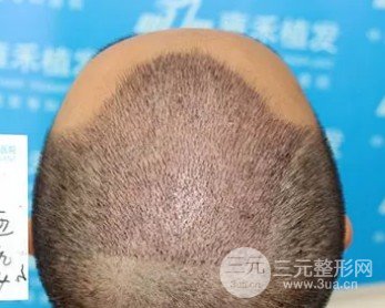 植发际线后面的头发还会长出来吗