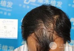植发际线后面的头发还会长出来吗,看看新鲜案例~ 植发际线后面的头发还会长出来吗,看看新鲜案例~