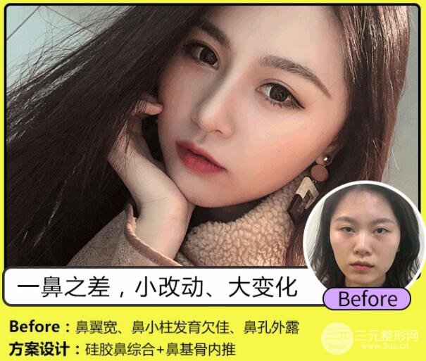 北京硅胶隆鼻价格贵么？科普来辣~