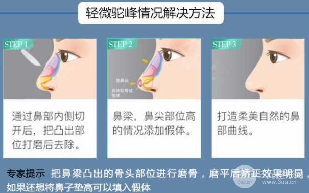 击穿谎言！驼峰鼻修复价格到底贵不贵？