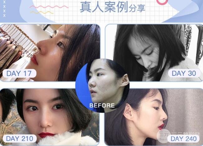 驼峰鼻修复案例图