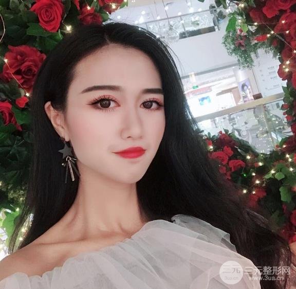 北京301郭伶俐双眼皮手术案例已经3个月了