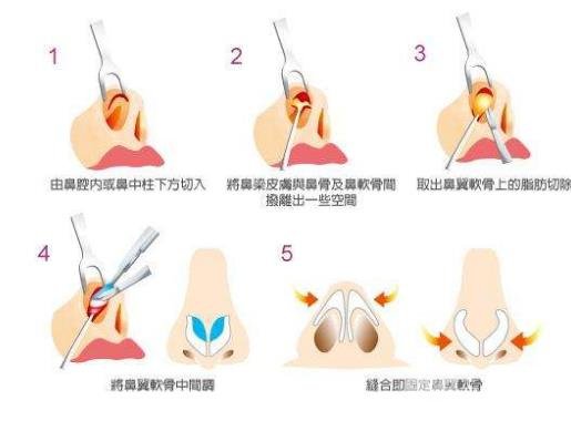 鼻头缩小手术价格