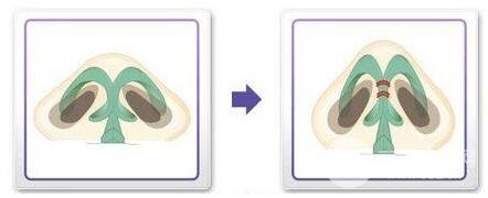 鼻头缩小手术的好处