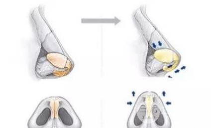 手术后该注意什么？