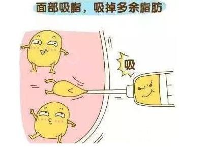 面部吸脂恢复期