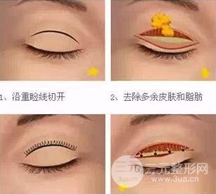 肿眼泡的福星：眼皮抽脂术果好不好~