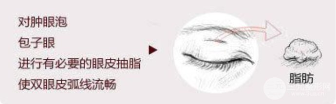 肿眼泡的福星：眼皮抽脂术果好不好~