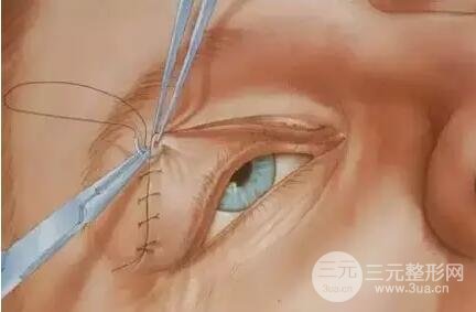 肿眼泡的福星眼皮抽脂术果好不好