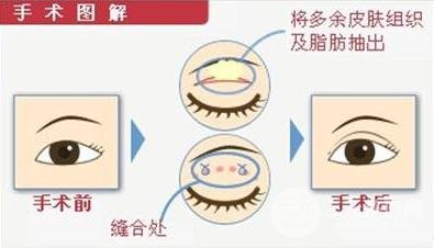 肿眼泡的福星：眼皮抽脂术果好不好~
