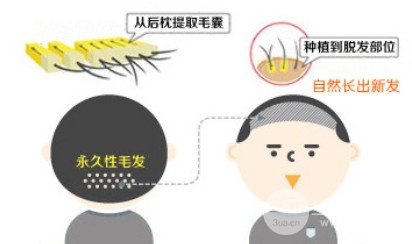 植发手术后要继续吃药吗
