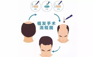 脱发都需要植发吗