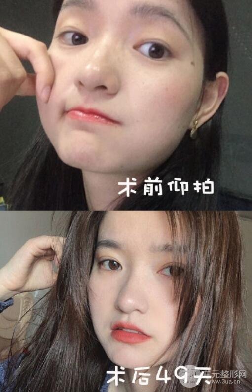 [美眼攻略]韩式开内眼角果图