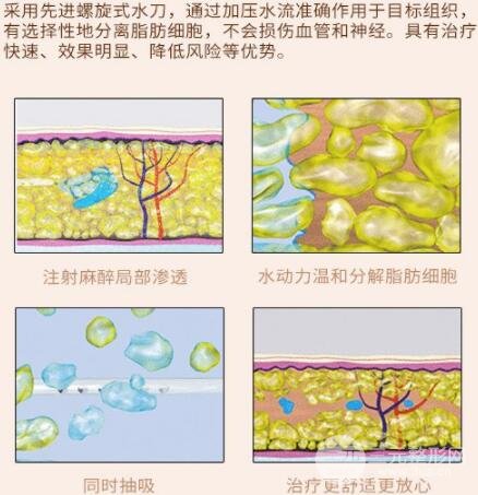 吸脂瘦大腿肿胀期是多久?教你如何护理