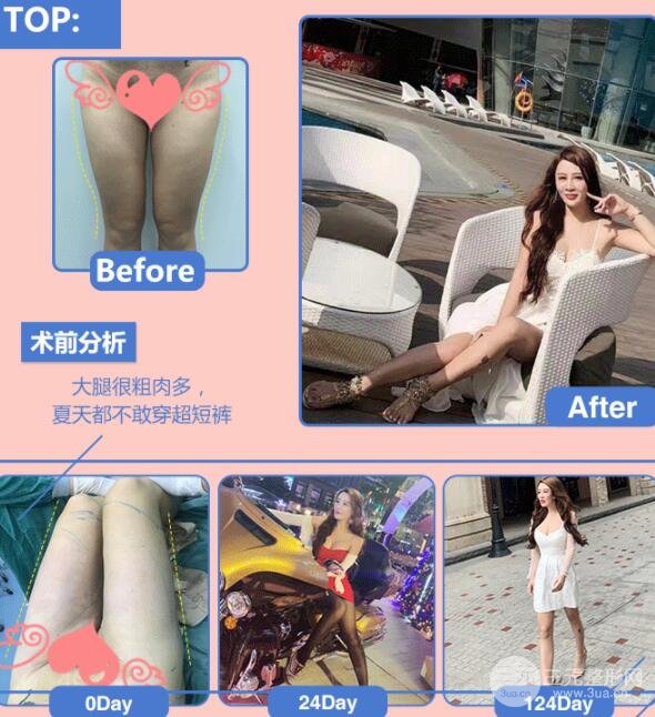 吸脂瘦大腿果图