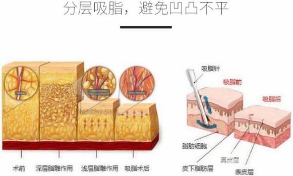 背部吸脂多少钱手术优势&果科普