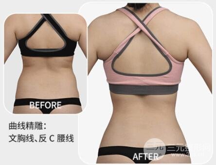 背部吸脂果图